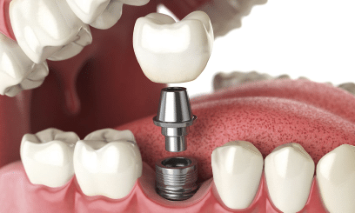 Which Country Should A person Choose to obtain Oral Implants?